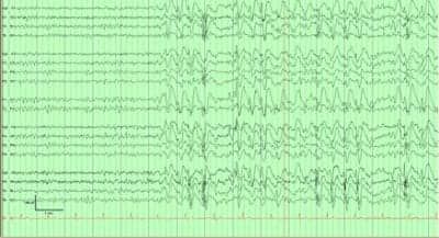 led exposure nocturnal epilepsy