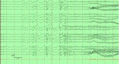 led exposure nocturnal epilepsy