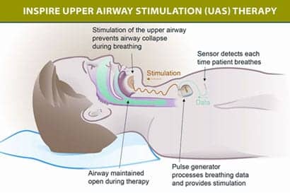 Implanted Inspire Upper Airway Stimulator Significantly Improves OSA