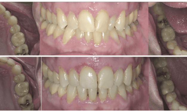 Orthodontic Strategies for Sleep Apnea