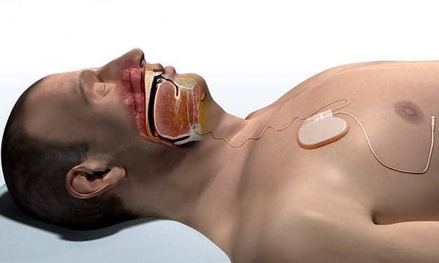Upper Airway Stimulation’s Impact on Sleep Apnea Comorbidities