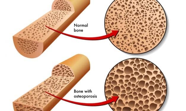 Orexin Proteins Linked to Bone Formation, Could Lead to New Osteoporosis Treatments