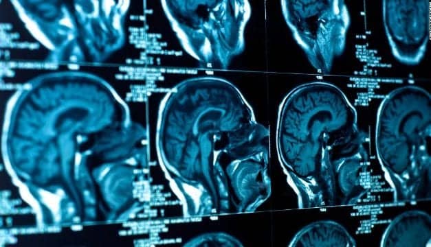 Are ‘Smart Pills’ the Best Way to Stay Sharp?