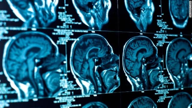 Are ‘Smart Pills’ the Best Way to Stay Sharp?