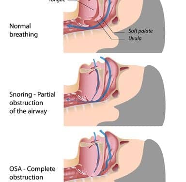 Snoring and Sleep Apnea | Understanding the Continuum