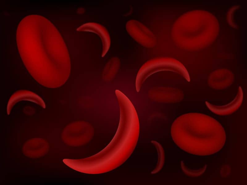 High Prevalence of Sleep-Disordered Breathing in Adults with Sickle Cell