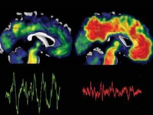 BetaAmyloid