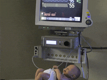 Clinical Trial Demonstrates Effectiveness of Infant Apnea Prevention Technology