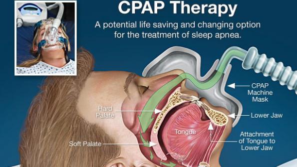 How to Fix Common CPAP Problems