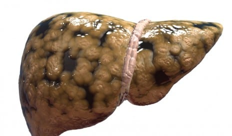 fatty liver