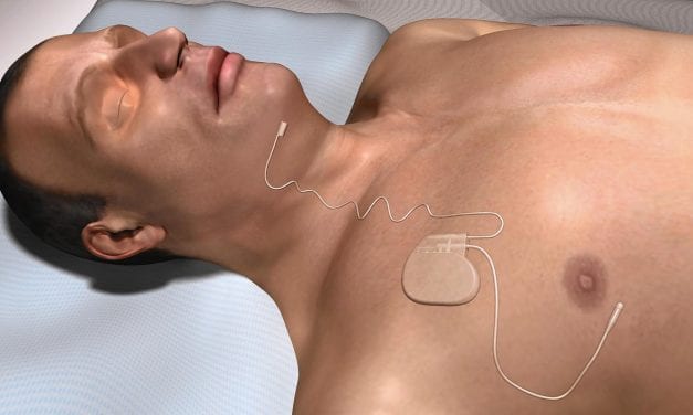 Upper Airway Stimulating Device Can Help Apnea Patients