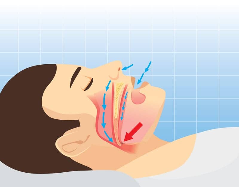 IDing of Neural Circuits That Rouse Brain to Breathe Could One Day Lead to Sleep Apnea Drugs That Open Airway Without Waking Patient