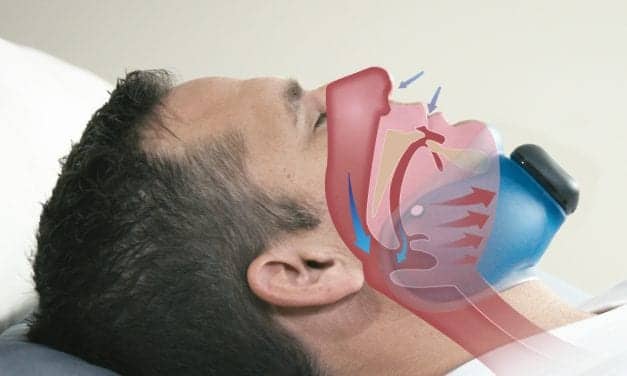 Evaluating a Potential New Treatment for Obstructive Sleep Apnea: Continuous Negative External Pressure