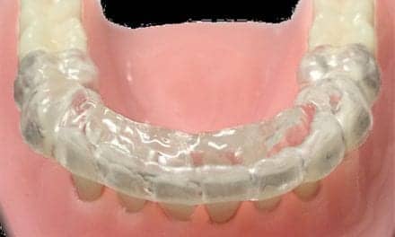 ProSomnus Morning Occlusal Guide [MOG] to Realign Mandible in Sleep Apnea Patients Using Oral Appliances