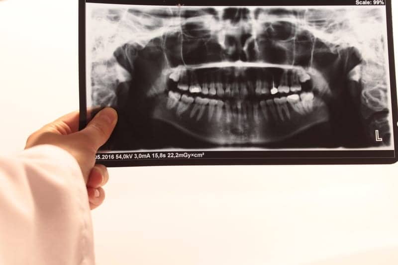 “Silent Sleep Apnea” Prevalent in Patients with Jaw Deformity