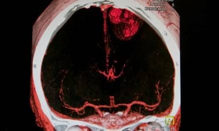 Insomnia Is Likely Long-term Side Effect of Stroke