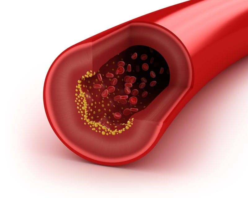 Fat Metabolism Linked to Sleep Apnea