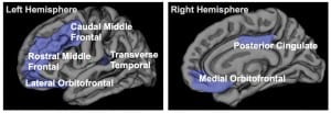 gray matter insomnia