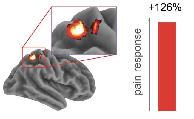 Sleep Loss Heightens Pain Sensitivity