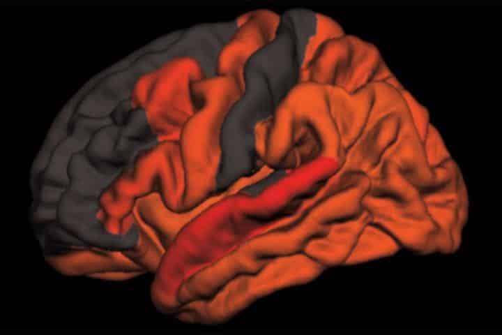 Toxic Brain Protein Tau Elevated in Older People Who Sleep Poorly