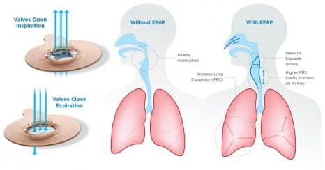 provent-therapy-mechanism-of-action