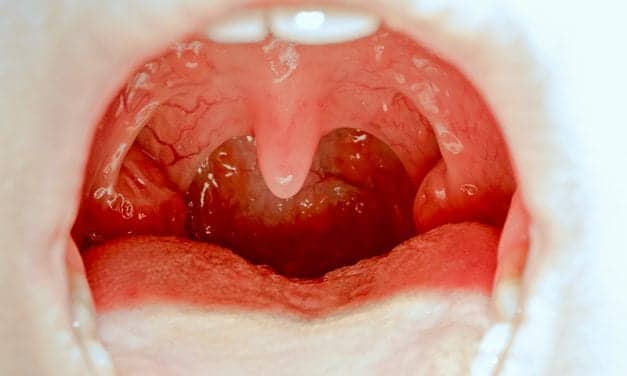 AAO-HNS Publishes Updated Tonsillectomy in Children Clinical Practice Guideline