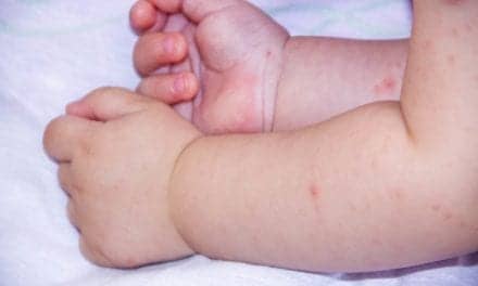 Moms of Kids with Eczema Report Sleep Troubles