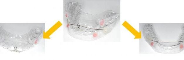 Researchers Measure Oral Appliance Airway Change Using Imaging Done in Supine—Not Upright—Position