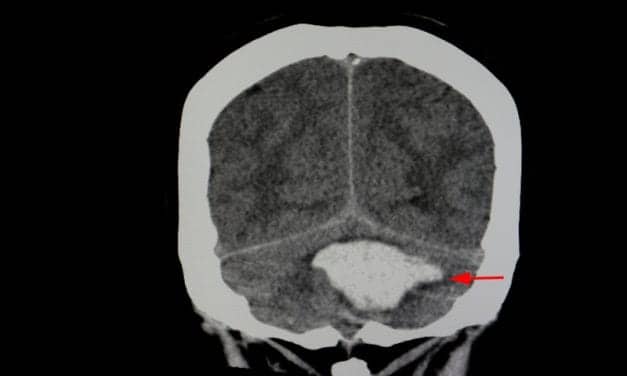 The Often-overlooked Connection Between Sleep Troubles and Stroke