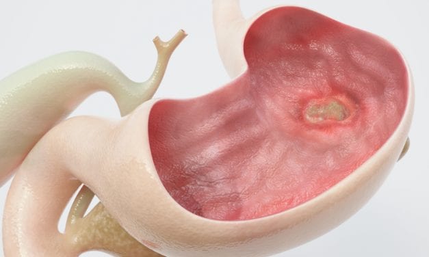 Poor Sleep Quality Linked to Recurrence of Peptic Ulcers