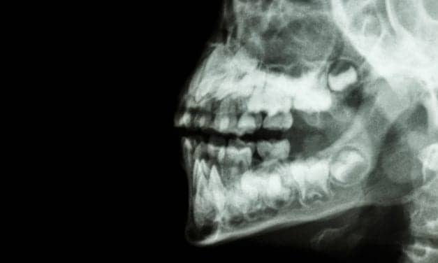 Jaw Surgery Improves Quality of Life in Obstructive Sleep Apnea Patients
