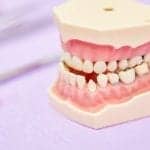 When an Open Airway Leads to an Open Bite