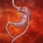 Society: Resume Bariatric and Metabolic Surgery Before COVID-19 Pandemic Is Over