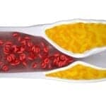 Sleep Scientists ID a Middleman Between Fragmented Sleep & Hardened Arteries