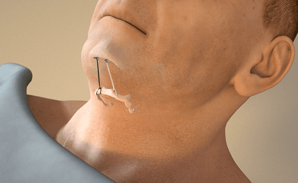 Hyoid Suspension + UPP Is Efficacious For Multilevel Obstructive Sleep Apnea Patients