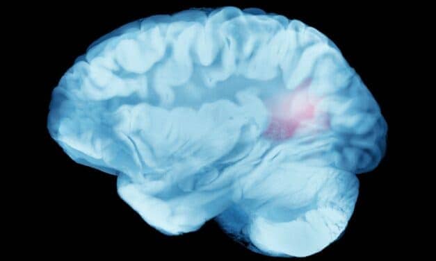 Insomnia May Be Risk Factor for Highly Fatal Brain Aneurysm Rupture