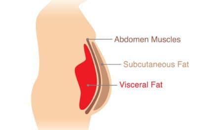 Lack of Sleep Increases Abdominal Visceral Fat