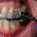 Morning Repositioners Minimize Side Effects of Oral Appliances
