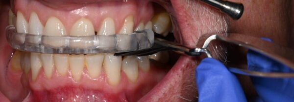 oral appliance side effect