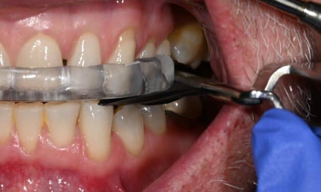 Morning Repositioners Minimize Side Effects of Oral Appliances
