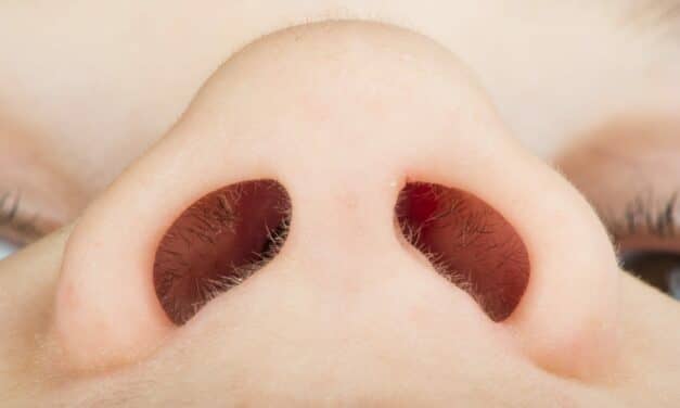 NasoClenz: Does Nasal Cleansing Increase Compliance in CPAP Patients?