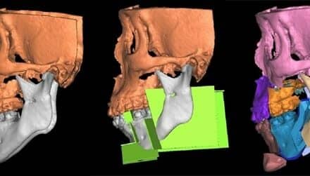 New Sleep Apnea Jaw Surgery Concept Lowers AHI But Maintains Physical Appearance