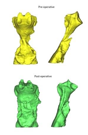 airway sleep apnea