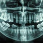 Sleep Apnea Tied to Low Bone Mineral Density