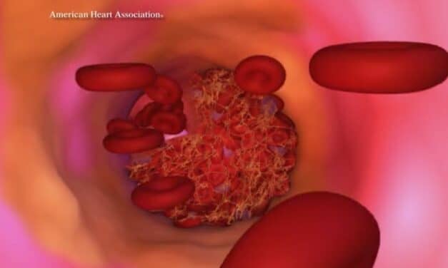 Sleep Irregularity Linked to Higher Risk of Atherosclerosis