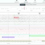 EnsoData’s Sleep Scoring Solution Hits One-Millionth Patient Milestone