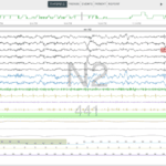 Real-Time Sleep Scoring Software Is Here. Can It Help Sleep Techs Score Studies for Hypersomnia?