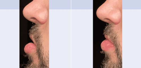 How to Promote Nasal Breathing with Oral Appliances