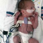 Wearable Device Aids in Detecting Apneas in Premature Infants