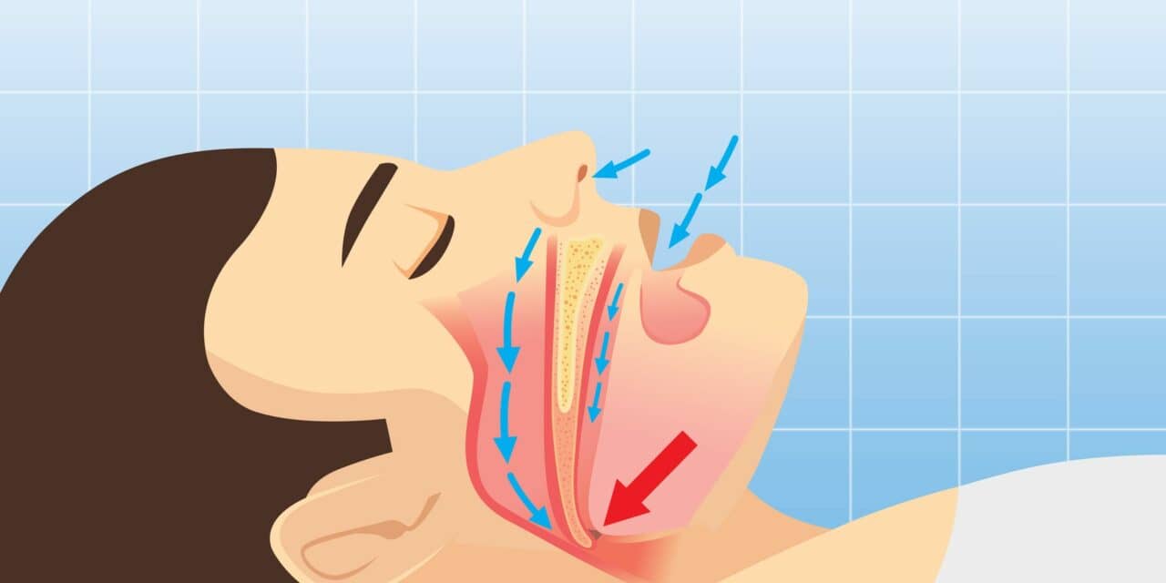 The Surprising Reason Sleep Surgeons Should Extend Airway Evaluation in Sleep Apnea Patients Undergoing DISE